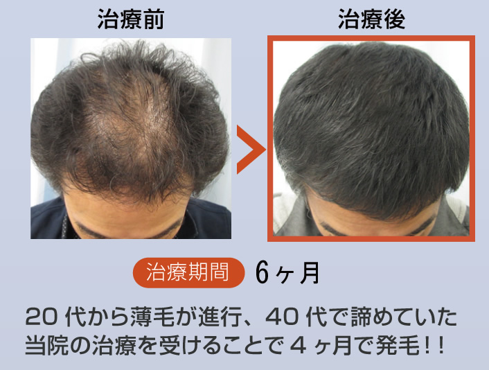 20代から薄毛が進行、40代で諦めていたが、当院の治療を受けることで4ヶ月で発毛