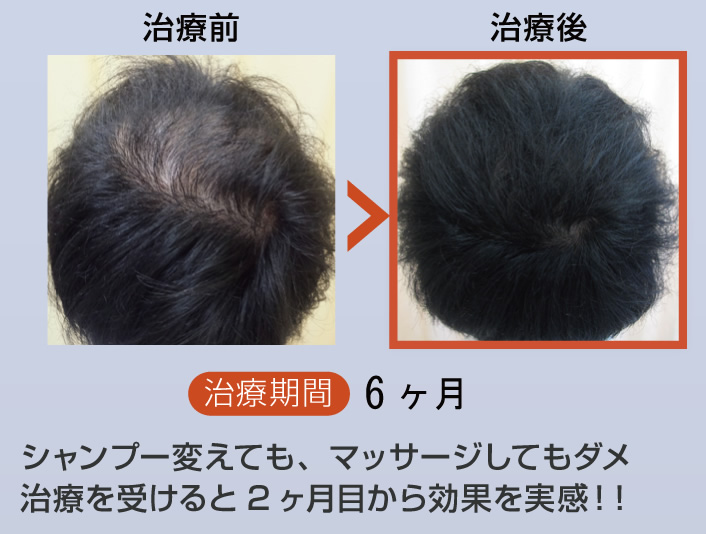 シャンプーを変えても、マッサージしてもダメ、治療を受けると2ヶ月目から効果を実感