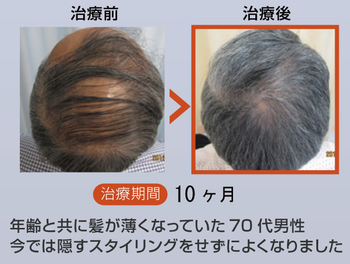 年齢と共に髪が薄くなっていた70代男性、今では隠すスタイリングをせずによくなりました