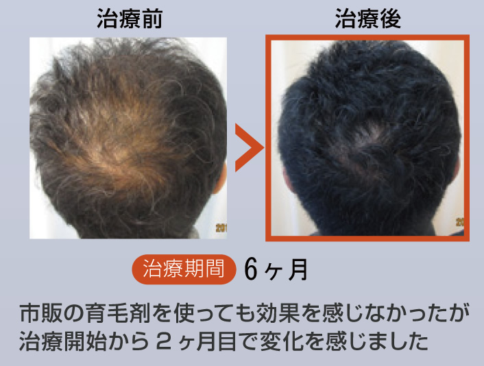 市販の育毛剤を使っても効果を感じなかったが、治療開始から2ヶ月目で変化を感じました
