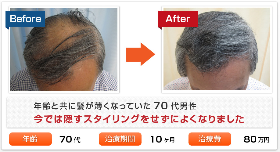 年齢と共に髪が薄くなっていた70代男性、今では隠すスタイリングをせずによくなりました