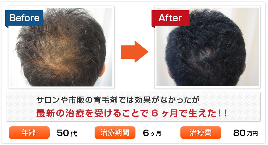 サロンや市販の育毛剤では効果がなかったが最新の治療を受けることで6ヶ月で生えた
