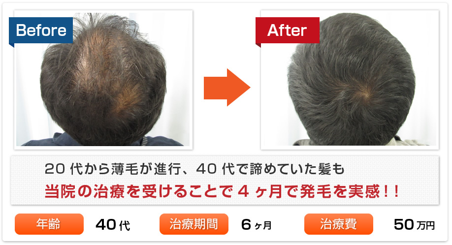 20代から薄毛が進行、40代で諦めていた髪も当院の治療を受けることで4ヶ月で発毛を実感