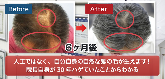 人工ではなく、自分自身の自然な髪の毛が生えます、院長自信が30年ハゲていたことからわかる
