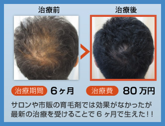 サロンや市販の育毛剤では効果がなかったが最新の治療を受けることで6ヶ月で生えた