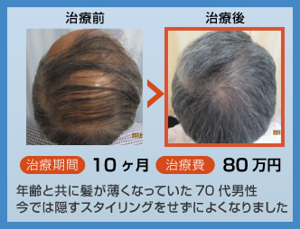 年齢と共に髪が薄くなっていた70代男性今では隠すスタイリングをせずによくなりました