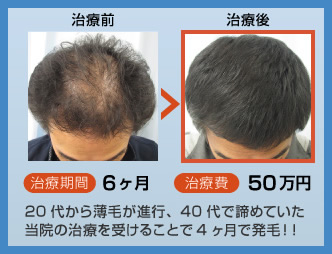20代で薄毛が進行し40代になって髪は諦めていたが、当院を知り望みをかけ治療を始めると、4ヶ月で発毛