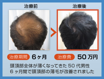 頭頂部全体が薄くなってきた50代男性、6ヶ月間で頭頂部の薄毛が改善されました