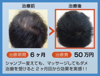 シャンプー変えても、マッサージしてもダメ、治療を受けると2ヶ月目から効果を実感