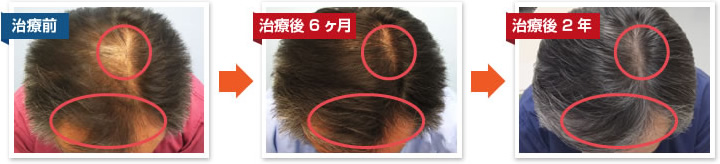 院長発毛実績