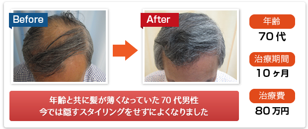 年齢と共に髪が薄くなっていた70代男性、今では隠すスタイリングをせずによくなりました