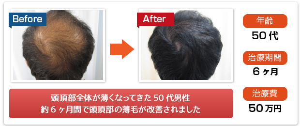 頭頂部全体が薄くなってきた50代男性、約6ヶ月で頭頂部の薄毛が改善されました