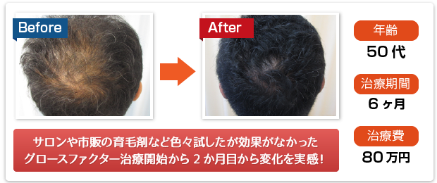 サロンや市販の育毛剤など色々試したが効果がなかった、グロスファクター治療開始から2ヶ月目から変化を実感