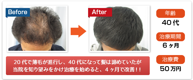20代で薄毛が進行し40代になって髪は諦めていたが、当院を知り望みをかけ治療を始めると、4ヶ月で改善