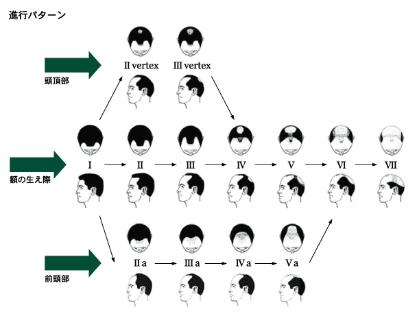 薄毛の進行パターン