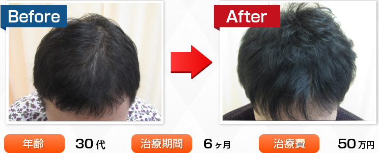 30代・治療期間6ヶ月・治療費50万
