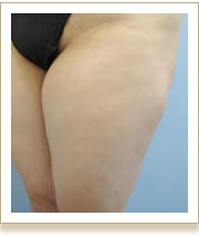 脂肪溶解注射 メソセラピー セルライト除去 痩身美容整形外科