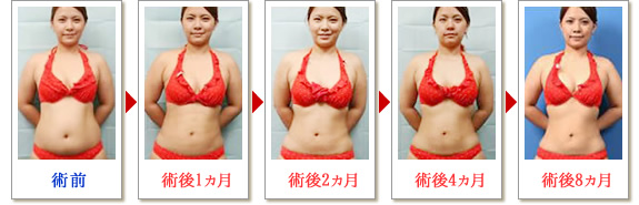 ベイザー脂肪吸引症例写真02-01