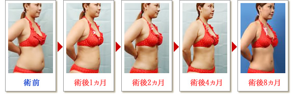 ベイザー脂肪吸引症例写真02-02