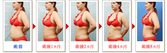 ベイザー脂肪吸引症例写真02-03