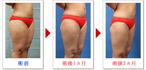 ベイザー脂肪吸引症例写真03-02