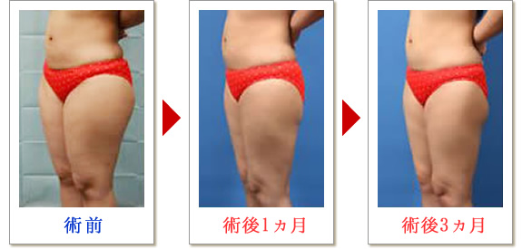 ベイザー脂肪吸引症例写真03-03