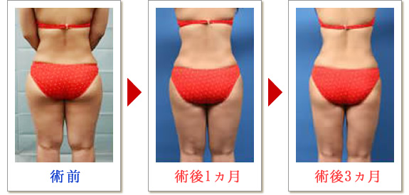 ベイザー脂肪吸引症例写真03-04