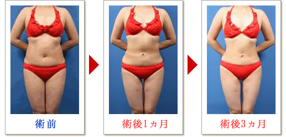 ベイザー脂肪吸引症例写真04-01