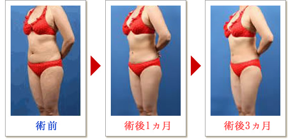 ベイザー脂肪吸引症例写真04-02