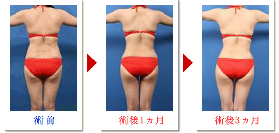 ベイザー脂肪吸引症例写真04-03