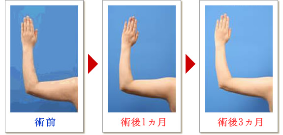 ベイザー脂肪吸引症例写真04-04